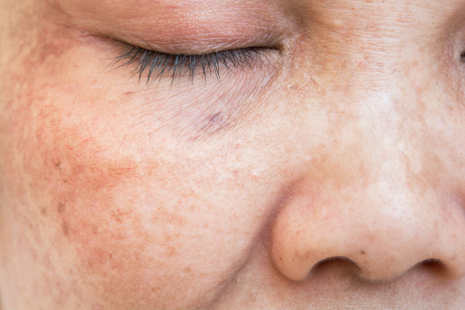 Discoloration