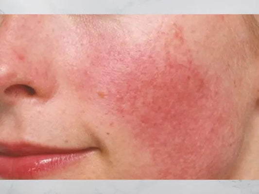 Sensitive Skin
