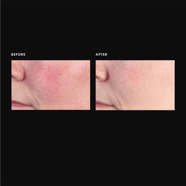 Anti-Redness Serum